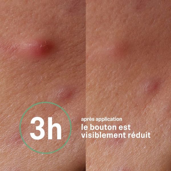 Respire soin Flash boutons peaux à imperfections 15g