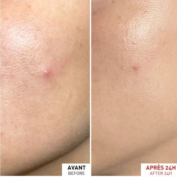 Erborian Centella SOS gel effet patch anti-imperfections 9ml