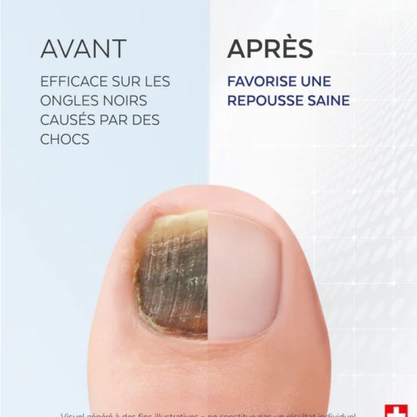 Poderm sérum fortifiant ongles noirs, traumatisés 8ml