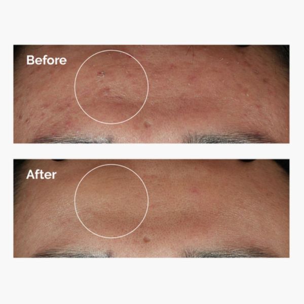 The Ordinary Niacinamide 10% + Zinc 1% 30ml