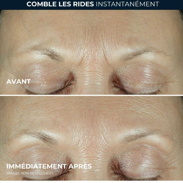 RoC Derm Correxion sérum combler + traiter 15ml