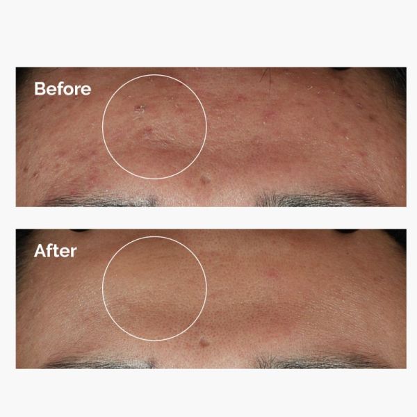 The Ordinary Niacinamide 10% + Zinc 1% Sérum Niacinamide 60ml