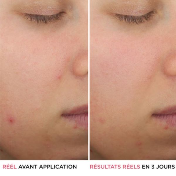 IT Cosmetics Bye Bye Breakout sérum anti acné à l'acide salicylique 30ml